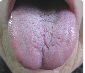 成都口腔黏膜科 裂纹舌       舌头增大肥厚,舌头边缘会出现牙齿印迹