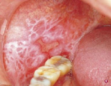 白塞氏病的危害症状有哪些